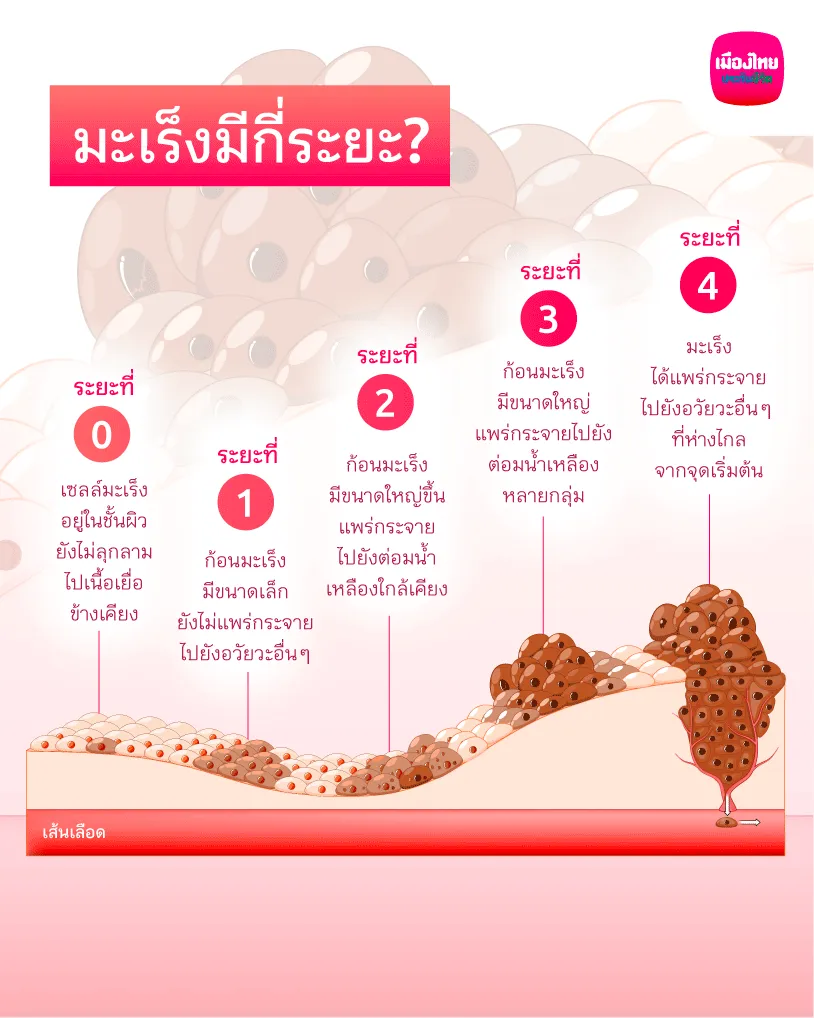 มะเร็งเกิดจากอะไร และมีกี่ระยะ?